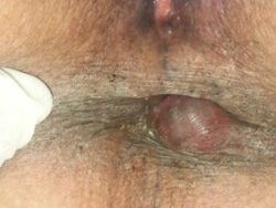 Anal Haematoma Anal Haematoma
