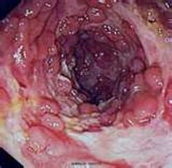 Chrones Disease Chrones Disease