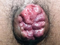 Internal Haemorrhoids Internal Haemorrhoids