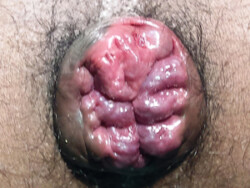 Internal Haemorrhoids Internal Haemorrhoids