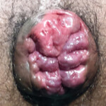 Internal Haemorrhoids Internal Haemorrhoids