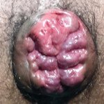 Internal Haemorrhoids Internal Haemorrhoids