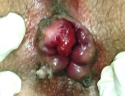 Interno-External Haemorrhoids Interno-External Haemorrhoids