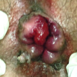 Interno-External Haemorrhoids Interno-External Haemorrhoids