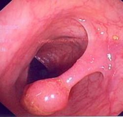 Rectal Polyp Rectal Polyp