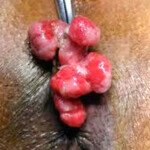Rectal Polyp Rectal Polyp