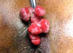 Rectal Polyp Rectal Polyp