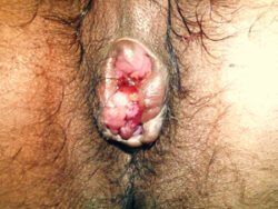 Thrombosed Internal Haemo Thrombosed Internal Haemo