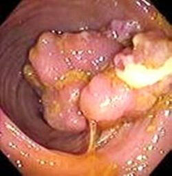 Adenocarcinoma of Rectum Adenocarcinoma of Rectum