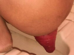 Complete Rectal Prolapse Complete Rectal Prolapse