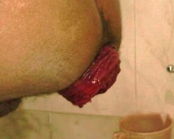 Complete Rectal Prolapsed Complete Rectal Prolapsed