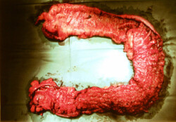 Crohns Disease Crohns Disease