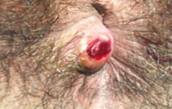 External Thrombosed Hemorrhoids External Thrombosed Hemorrhoids