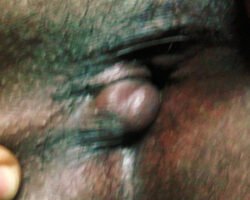 External Thrombosed Hemorrhoids External Thrombosed Hemorrhoids