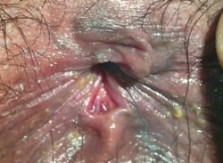 Fissure -In - Ano Fissure -In - Ano