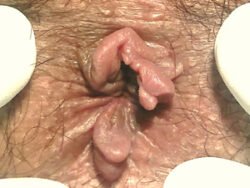 Fissure With Antero Posterior Sentinel Tags Fissure With Antero Posterior Sentinel Tags