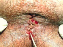 Fistula In Ano Fistula In Ano