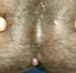 Fistular Opening Fistular Opening