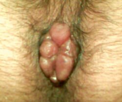 Immflamed External Haemorrhoids Immflamed External Haemorrhoids