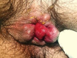 Interno External Haemorrhoids Interno External Haemorrhoids