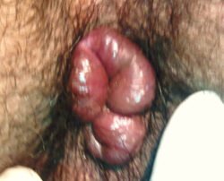 Mucosal Prolapse Mucosal Prolapse