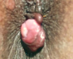 Posterior Hypertrophied Papilla Posterior Hypertrophied Papilla