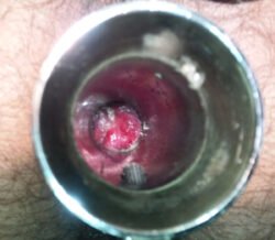 Proctoscopic View of Internal Hemorrhoids Proctoscopic View of Internal Hemorrhoids