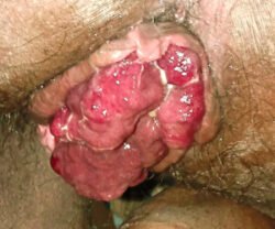 Prolapsed Hemorrhoids Prolapsed Hemorrhoids