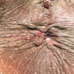 Pruritis Ani Pruritis Ani