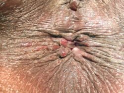 Pruritis Ani Pruritis Ani