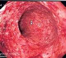 Ulcerative Colitis Ulcerative Colitis