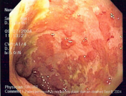 Ulcerative Colitis Ulcerative Colitis